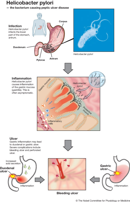 how do you say helicobacter pylori in spanish